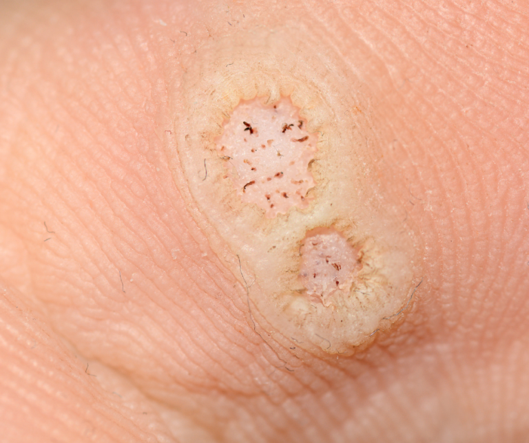 close-up of two plantar warts on bottom of foot
